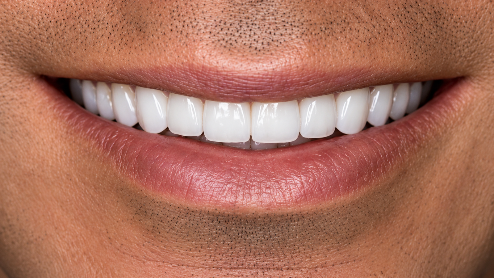 hollywood smile chandigarh